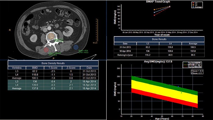 bone mineral analysis thumbnail