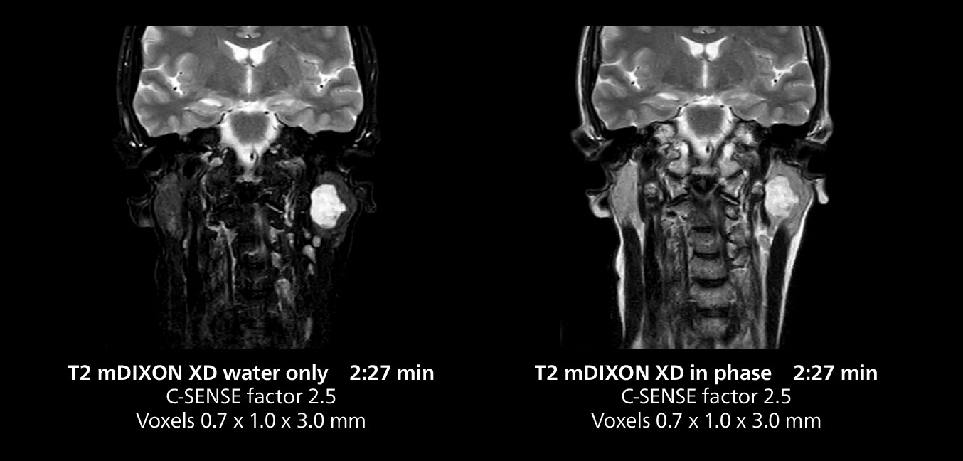 Salivary gland mri two