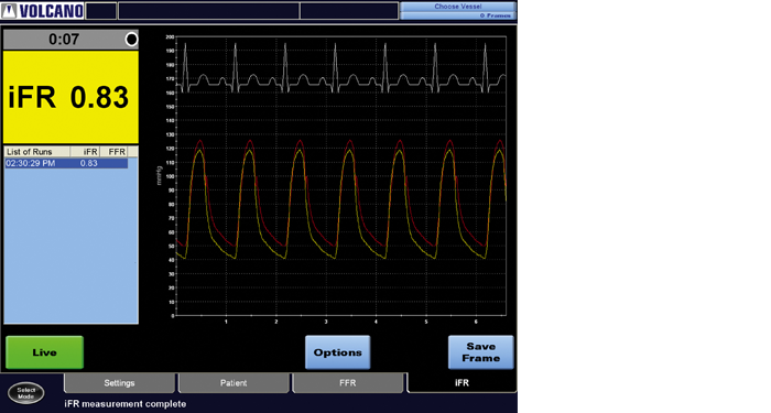 ifr scout ifr screen