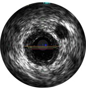 ivus interpretation assessment of vessel size