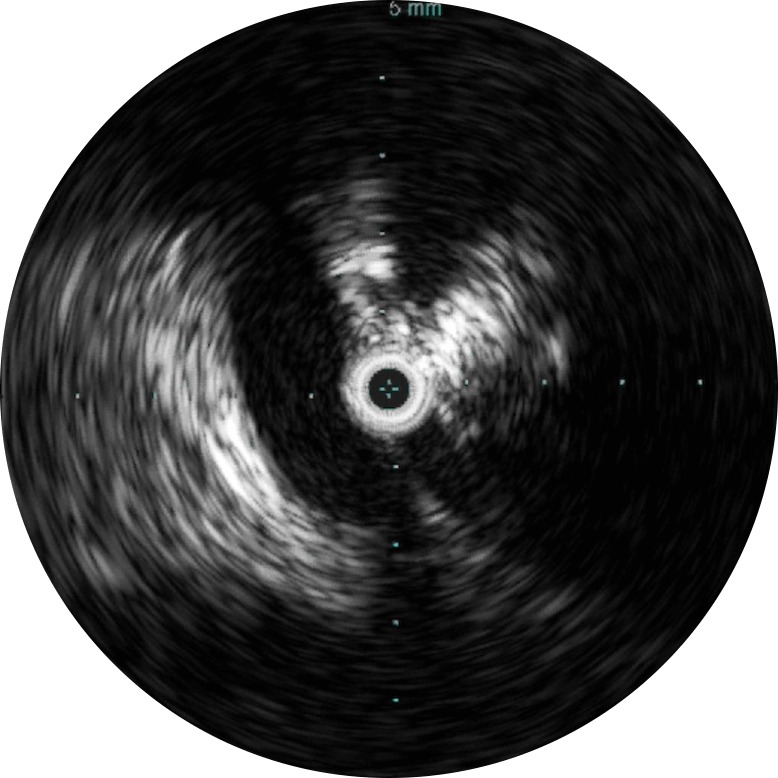 Why IVUS button