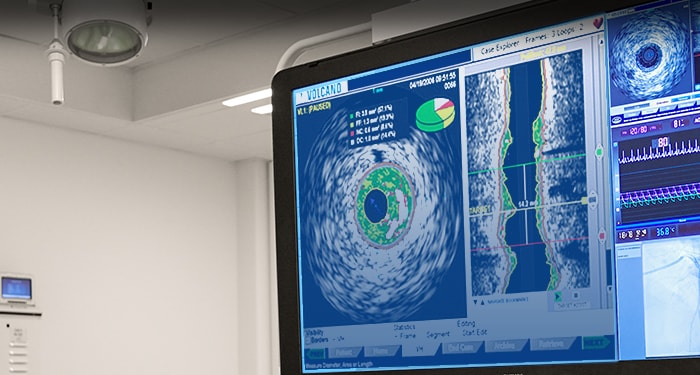 VH IVUS