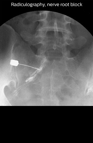 Radiculography, nerve root block