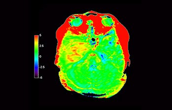 Astrocytoma image