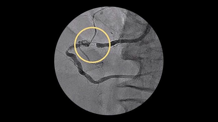 In-stent restenosis