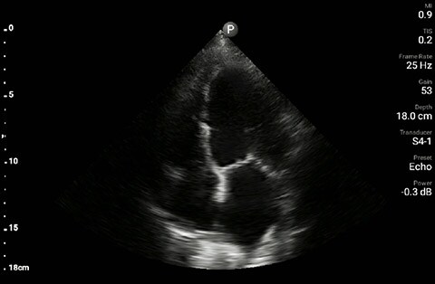 dyspnea image