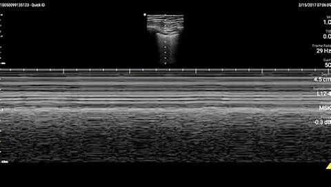 M-mode demonstrating lung sliding