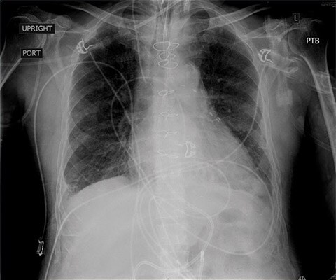 CXR image