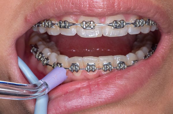 orthodontic-appliances-pic-5