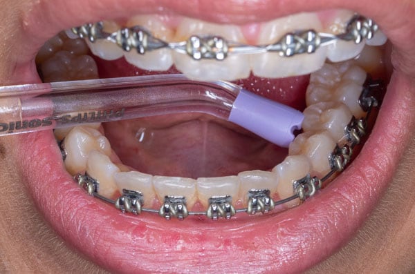 orthodontic-appliances-pic-4
