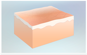 Uw huid bestaat uit meerdere lagen
